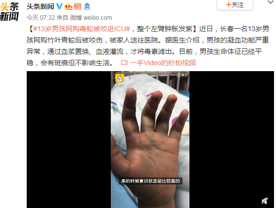 13歲男孩網購毒蛇被咬進ICU 整個左臂腫脹發(fā)紫